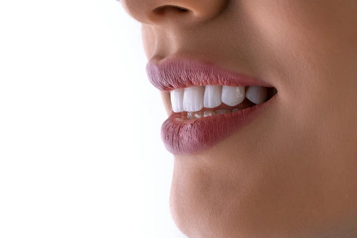 Primer plano de una sonrisa que representa la rehabilitación dental